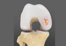 Chondral or Articular Cartilage